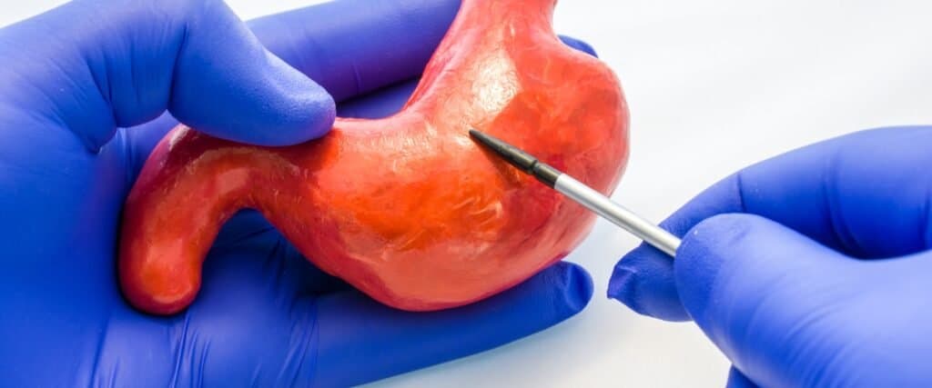 Cómo Gestionar las Deficiencias Nutricionales Después de la Cirugía Bariátrica: Un Enfoque Integral